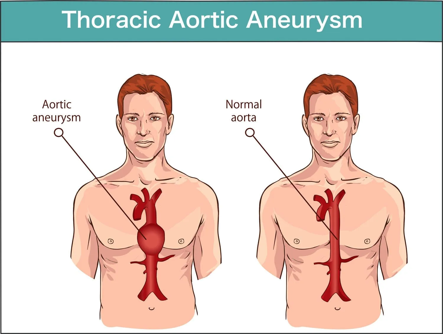 A medical diagram comparing a thoracic aortic aneurysm to a normal aorta